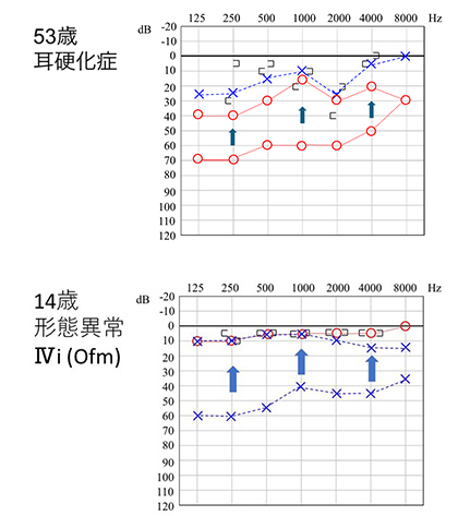 聴力検査結果