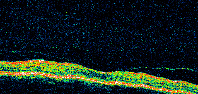 図 73 OCT図