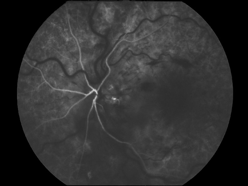 図 04 choroidal flush