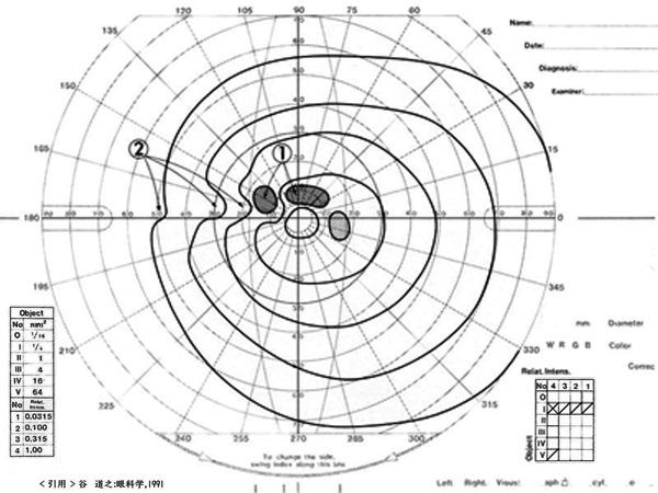 図 05 緑内障視野