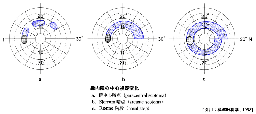 図 06 緑内障視野