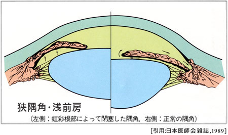 図 02 狭隅角