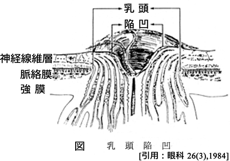 図 13 陥凹