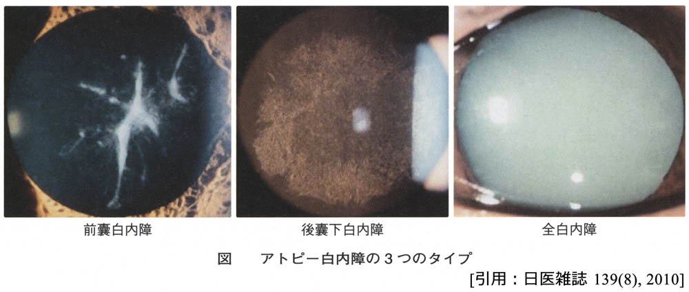 図 15 アトピー