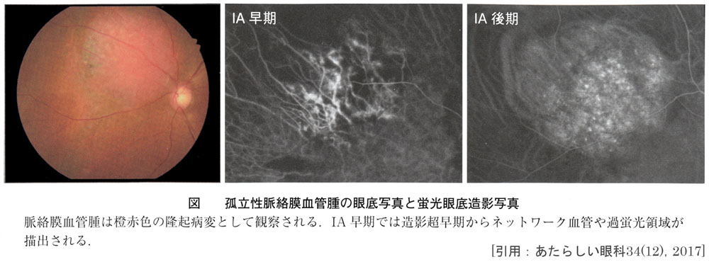 図 18 孤立血管腫