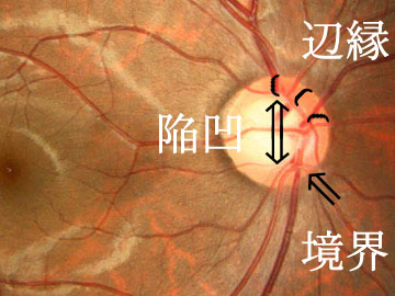 図 16 視神経乳頭
