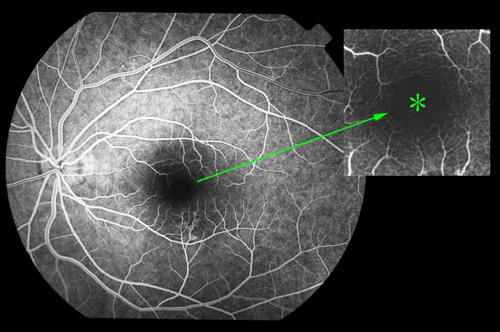 foveal avascular zone：＊をクリック