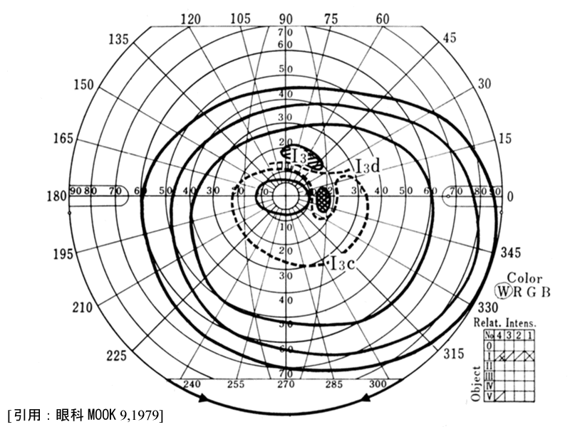 緑内障視野Ⅱa1