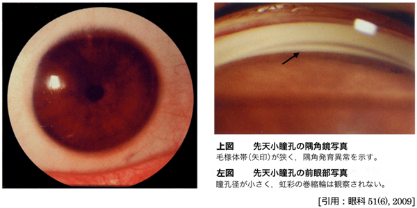 図 08 小角膜