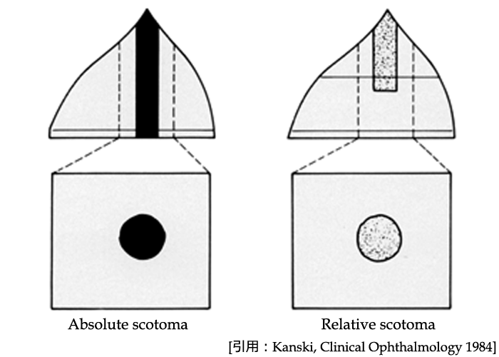 図02 暗点