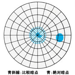 図03 中心暗点