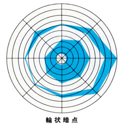 図05 輪状暗点