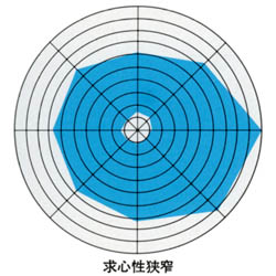 図06求心狭窄