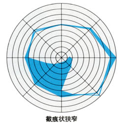 図07截痕狭窄