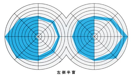 図10同名半盲