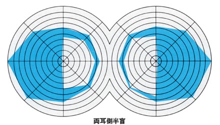 図11異名半盲