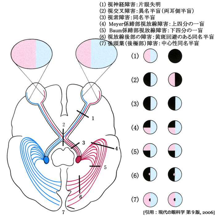 図12視路障害