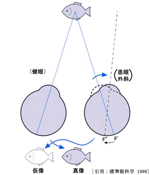 図 03 複視