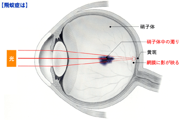 図 01 飛蚊症