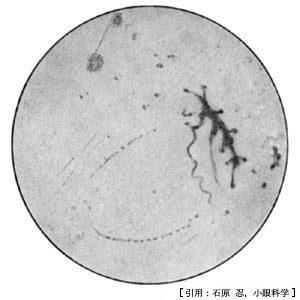 図 02 飛蚊症