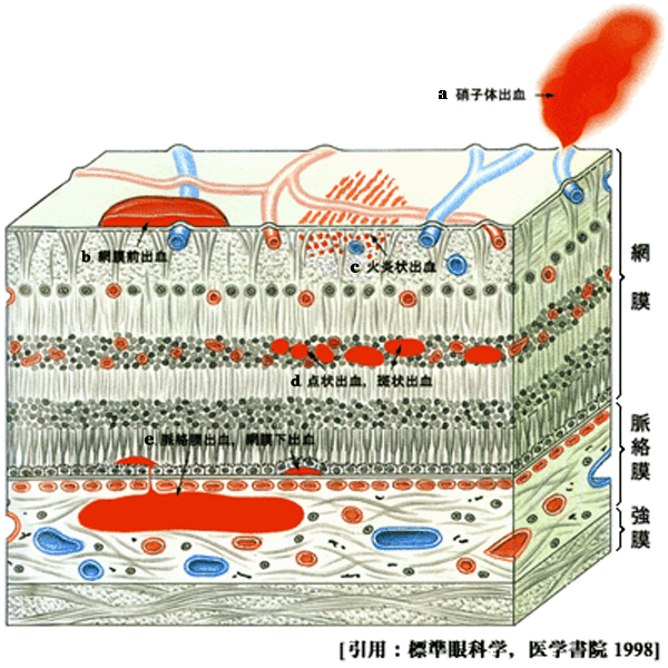 図 02 出血形態２