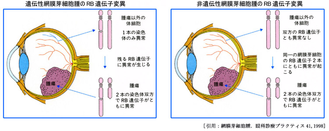網膜芽細胞腫