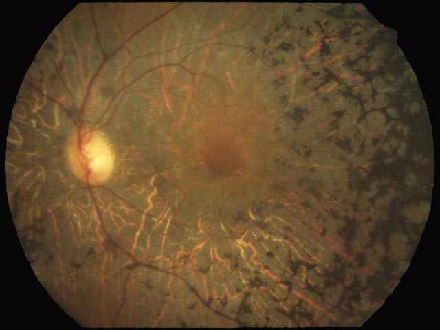 図 67 網膜色素変性