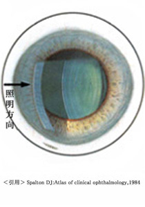 ①細隙灯顕微鏡所見