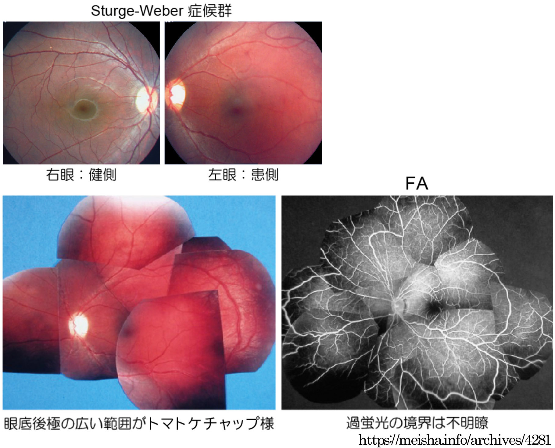 図 補 びまん性血管腫