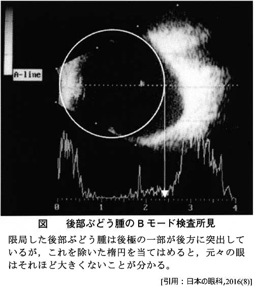 図 08 後部ぶどう腫