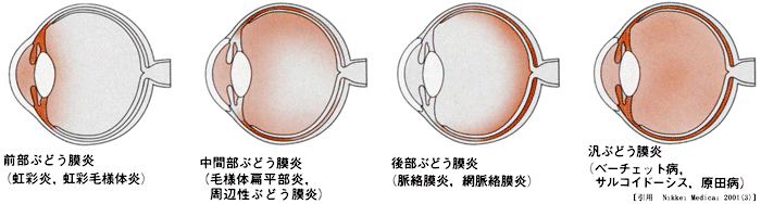 図 15 uveitis